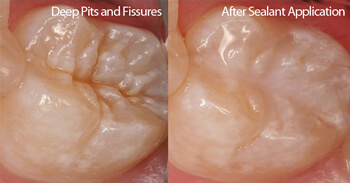 What is a fissure sealant?